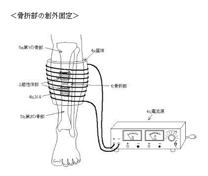 創外固定器